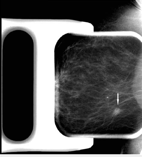 mammogram compression test|diagnostic mammogram with spot compression.